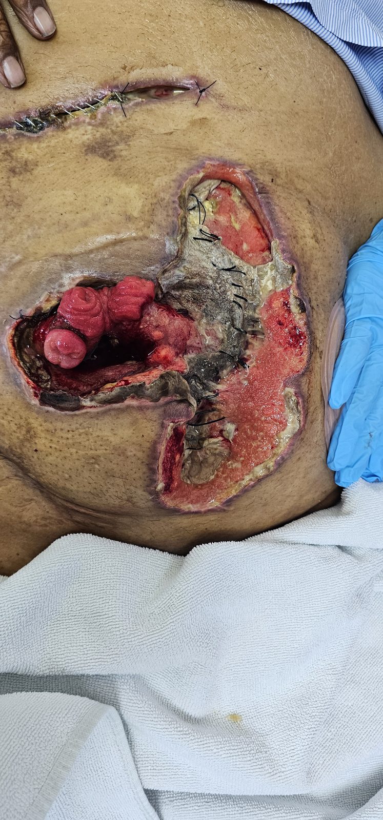 Surgical wound