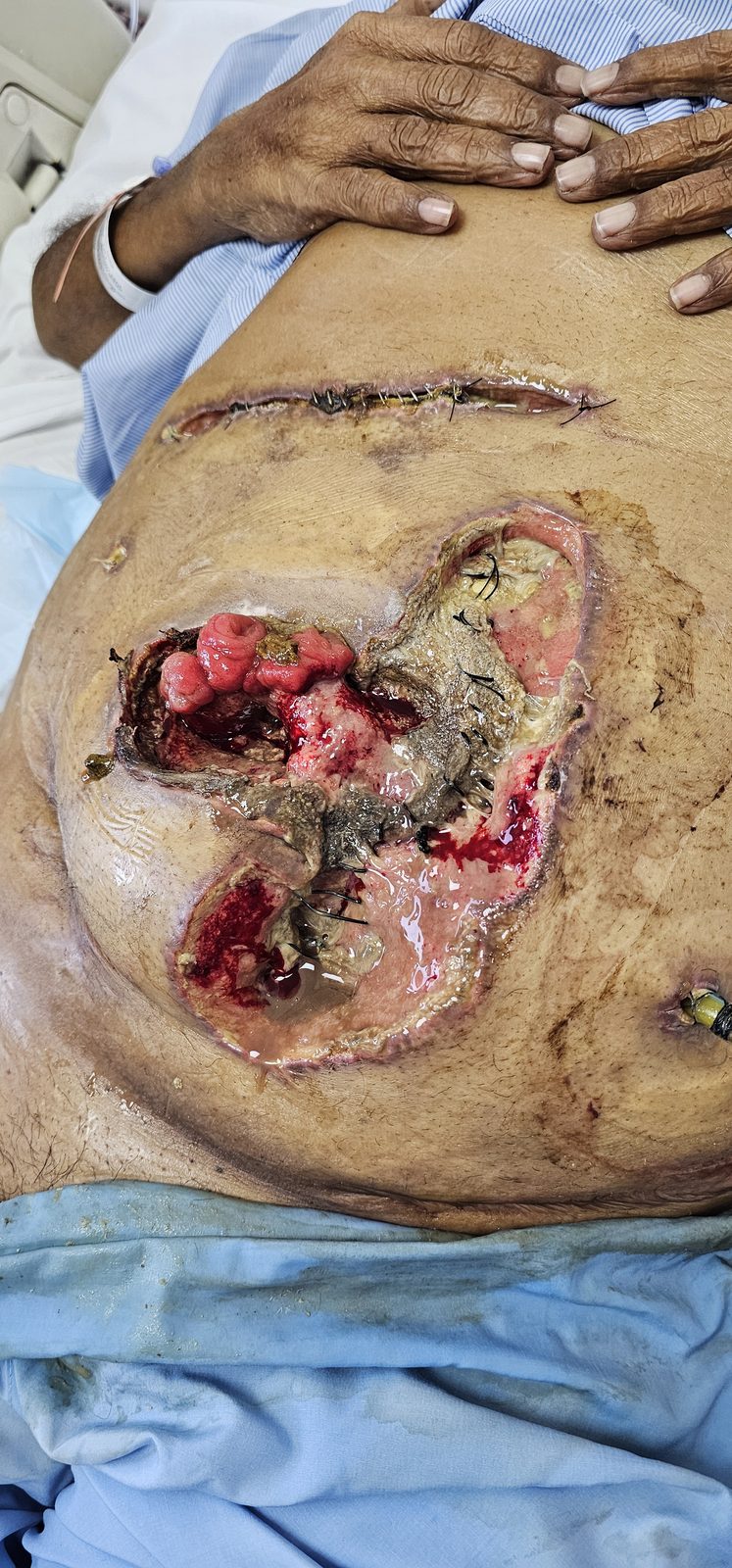 Surgical wound