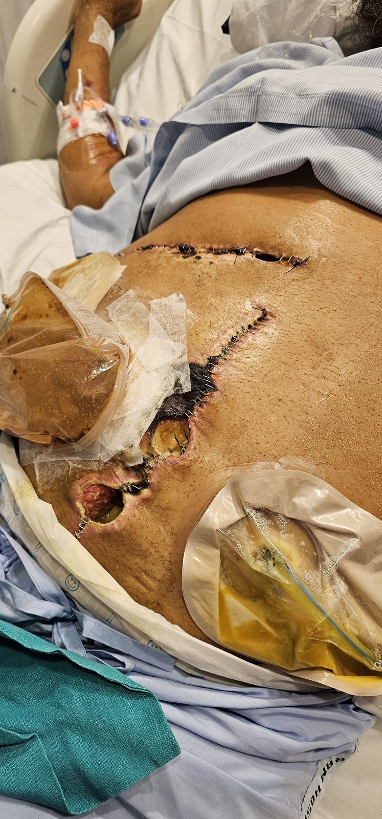 Surgical wound