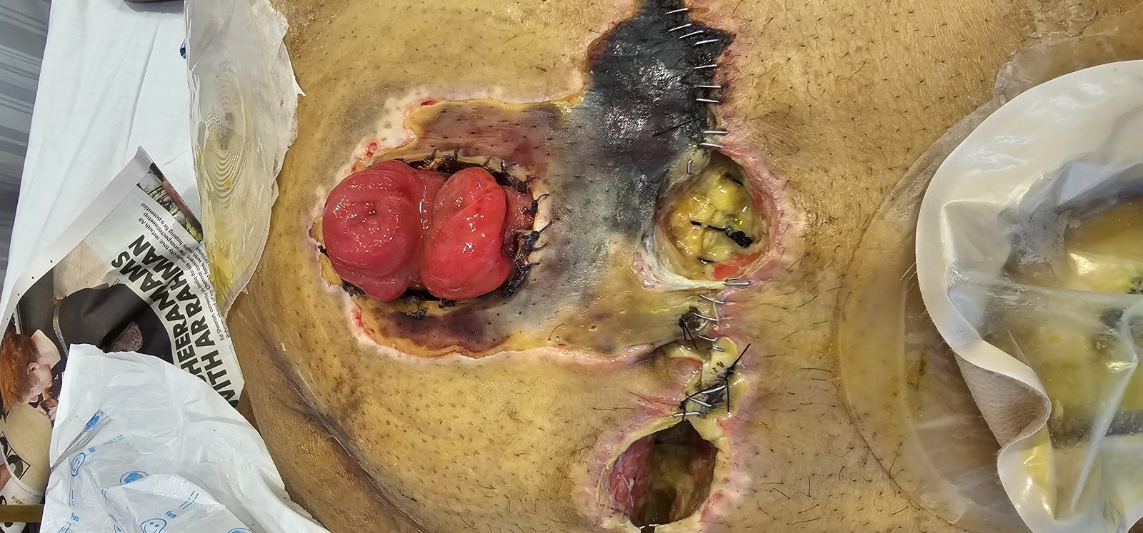 Surgical wound